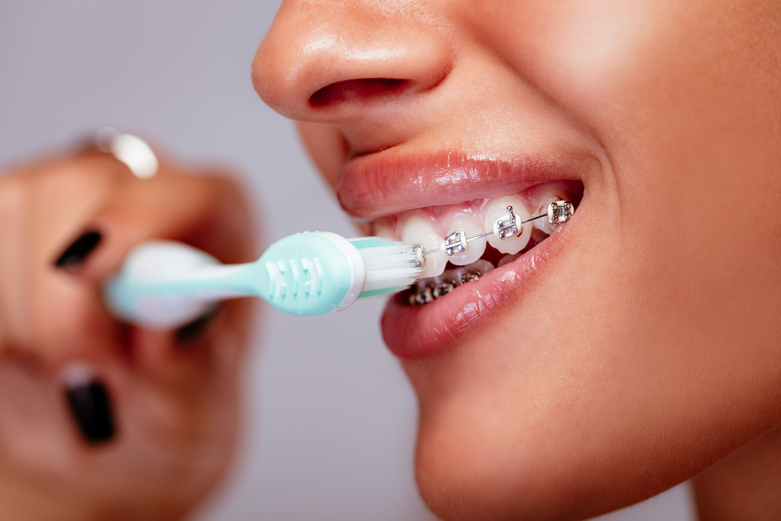 como escovar os dentes com aparelho